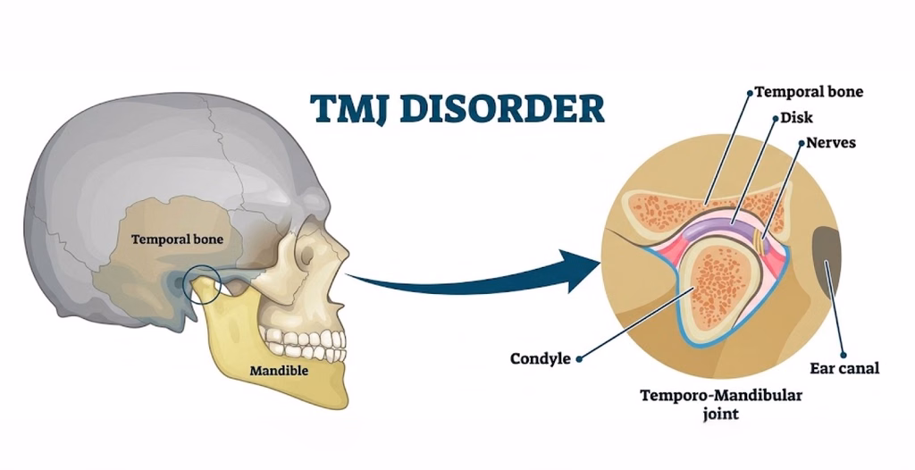 Anatomical diagram of human skull labeling TMJ disorder components including Mandible, Condyle, Disk, and Ear canal.