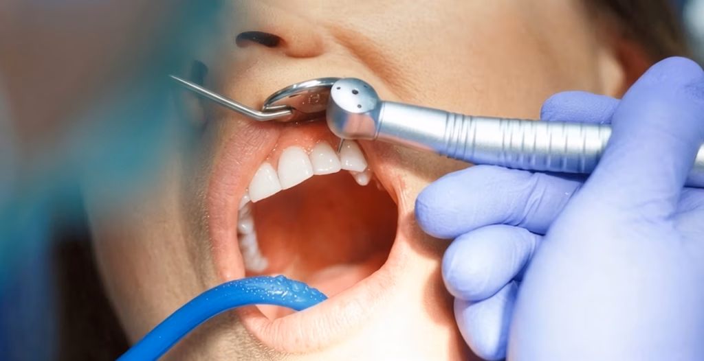 A close-up photograph of a dentist's hands in purple gloves using a dental drill on a patient's front tooth.
